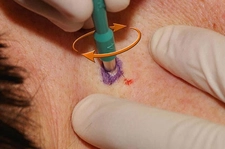 Biyopsi Nedir ve Nasıl Yapılır?