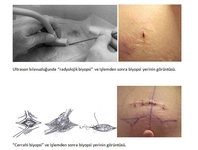 Meme Biyopsisi Özellikleri ve Faydaları Nelerdir?