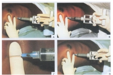 Vakum Biyopsi Özellikleri ve Faydaları Nelerdir?