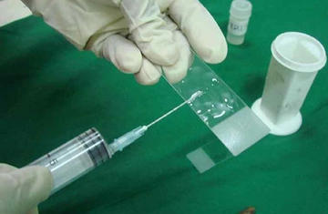 İnce İğne Aspirasyon Biyopsisi Özellikleri ve Faydaları Nelerdir?