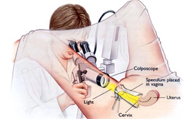Kolposkopik Biyopsi Özellikleri ve Faydaları Nelerdir?